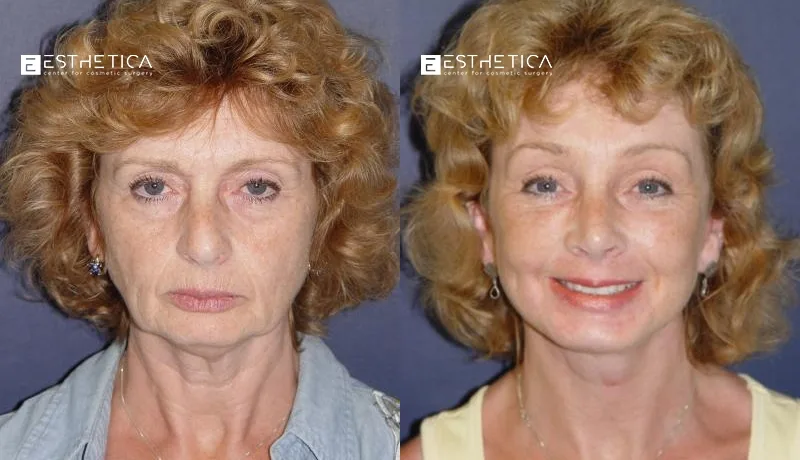 Facelift before and after — Case #2926