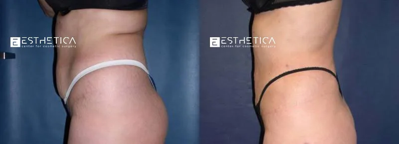 Liposuction before and after — Case #3693