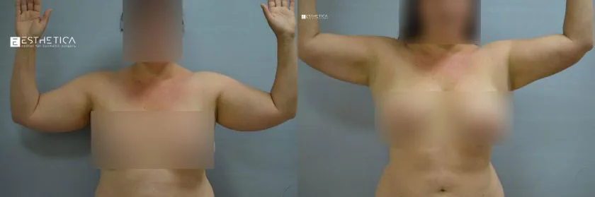 Liposuction before and after — Case #3720