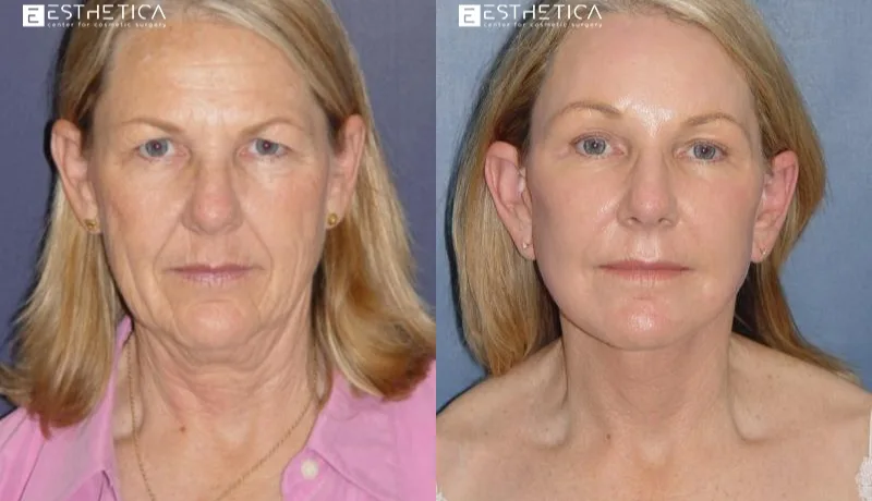 Neck Lift before and after — Case #2892