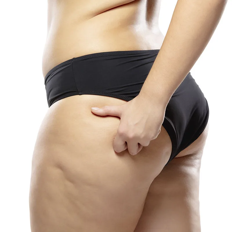Liposuction